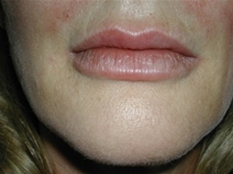 Dermal Fillers After Photo by Jonathan Kramer, MD; Meridian, ID - Case 20016