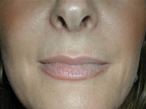 Dermal Fillers Before Photo by Jonathan Kramer, MD; Meridian, ID - Case 20016