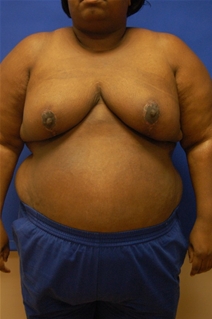 Breast Reduction After Photo by Randy Proffitt, MD; Mobile, AL - Case 21852