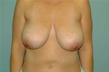 Breast Lift Before Photo by Richard Wassermann, MD, MPH, FACS; Columbia, SC - Case 21953