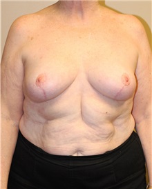 Breast Reduction After Photo by Meegan Gruber, MD, PhD; Tampa, FL - Case 22458