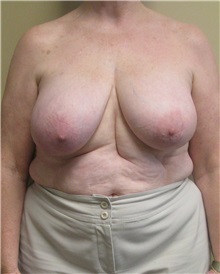 Breast Reduction Before Photo by Meegan Gruber, MD, PhD; Tampa, FL - Case 22458