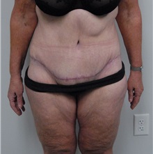 Body Contouring After Photo by Jonathan Hall, MD; Stoneham, MA - Case 23525
