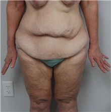 Body Contouring Before Photo by Jonathan Hall, MD; Stoneham, MA - Case 23525