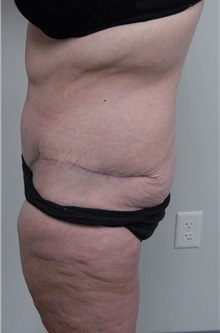 Body Contouring After Photo by Jonathan Hall, MD; Stoneham, MA - Case 23525