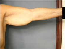 Arm Lift Before Photo by Ellen Janetzke, MD; Bloomfield Hills, MI - Case 25140