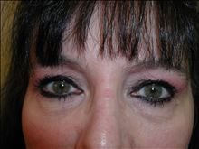 Eyelid Surgery Before Photo by David Abramson, MD; Englewood, NJ - Case 25327