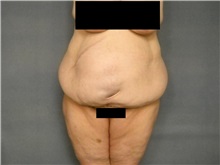 Body Contouring Before Photo by Ellen Janetzke, MD; Bloomfield Hills, MI - Case 25818