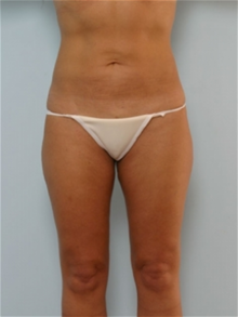 Liposuction After Photo by Paul Vitenas, Jr., MD; Houston, TX - Case 25994