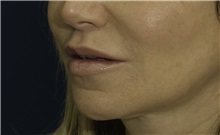 Dermal Fillers After Photo by Ricardo Rodriguez, MD; Lutherville-Timonium, MD - Case 27033