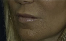 Dermal Fillers Before Photo by Ricardo Rodriguez, MD; Lutherville-Timonium, MD - Case 27033