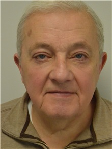 Eyelid Surgery After Photo by Jonathan Hall, MD; Stoneham, MA - Case 27211