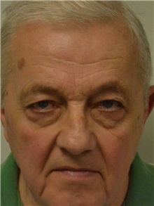 Eyelid Surgery Before Photo by Jonathan Hall, MD; Stoneham, MA - Case 27211