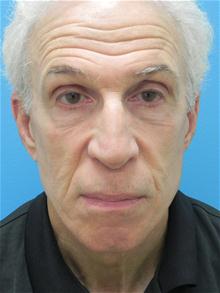 Facelift After Photo by Michael Epstein, MD, FACS; Northbrook, IL - Case 27683