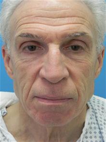 Facelift Before Photo by Michael Epstein, MD, FACS; Northbrook, IL - Case 27683