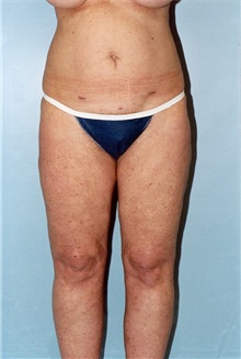 Liposuction After Photo by Kristoffer Ning Chang, MD; San Francisco, CA - Case 28247