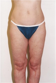 Liposuction Before Photo by Kristoffer Ning Chang, MD; San Francisco, CA - Case 28247