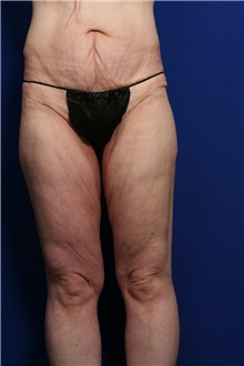 Body Contouring Before Photo by Joseph Mlakar, MD, FACS; Fort Wayne, IN - Case 29511