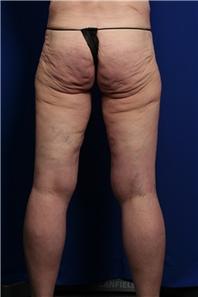 Body Contouring Before Photo by Joseph Mlakar, MD, FACS; Fort Wayne, IN - Case 29511