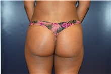 Buttock Lift with Augmentation After Photo by Michael Dobryansky, MD, FACS; Garden City, NY - Case 30296
