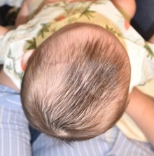 Craniosynostosis After Photo by Rachel Ruotolo, MD; Garden City, NY - Case 30310