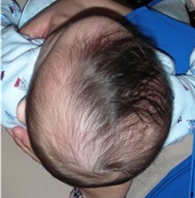 Craniosynostosis Before Photo by Rachel Ruotolo, MD; Garden City, NY - Case 30310