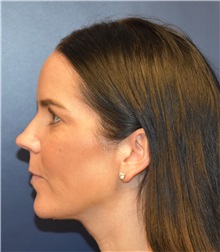 Liposuction After Photo by Richard Reish, MD, FACS; New York, NY - Case 30572