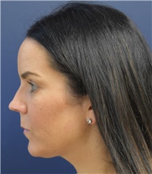 Liposuction Before Photo by Richard Reish, MD, FACS; New York, NY - Case 30572