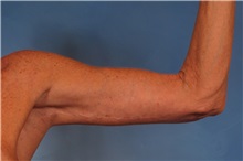Arm Lift After Photo by Kent Hasen, MD; Naples, FL - Case 30692
