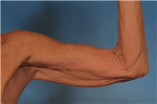 Arm Lift Before Photo by Kent Hasen, MD; Naples, FL - Case 30692