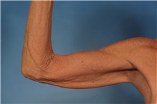 Arm Lift Before Photo by Kent Hasen, MD; Naples, FL - Case 30692
