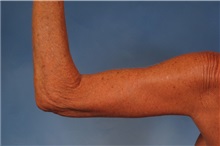 Arm Lift After Photo by Kent Hasen, MD; Naples, FL - Case 30692