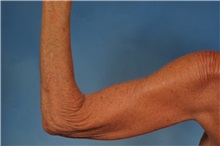 Arm Lift Before Photo by Kent Hasen, MD; Naples, FL - Case 30692