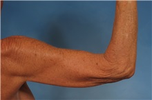 Arm Lift Before Photo by Kent Hasen, MD; Naples, FL - Case 30692