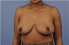 Breast Reduction After Photo by Trent Douglas, MD; Knoxville, TN - Case 31413