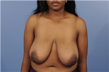 Breast Reduction Before Photo by Trent Douglas, MD; Knoxville, TN - Case 31413