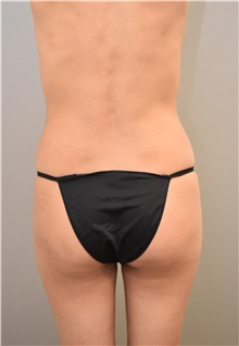 Buttock Lift with Augmentation Before Photo by Keshav Magge, MD; Bethesda, MD - Case 31641