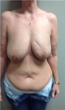 Breast Reconstruction Before Photo by Anureet Bajaj, MD; Oklahoma City, OK - Case 31652