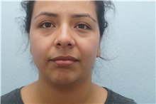 Ear Surgery After Photo by Keith Neaman, MD; Salem, OR - Case 31658