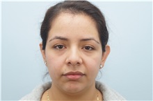 Ear Surgery Before Photo by Keith Neaman, MD; Salem, OR - Case 31658