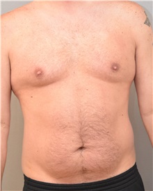 Liposuction Before Photo by Keshav Magge, MD; Bethesda, MD - Case 31693
