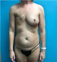 Breast Reconstruction Before Photo by Anureet Bajaj, MD; Oklahoma City, OK - Case 31696