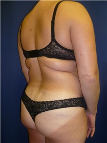Buttock Lift with Augmentation Before Photo by Mark Markarian, MD, MSPH, FACS; Wellesley, MA - Case 31810