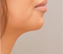 Liposuction After Photo by Keshav Magge, MD; Bethesda, MD - Case 31822