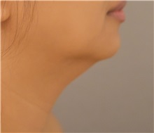 Liposuction Before Photo by Keshav Magge, MD; Bethesda, MD - Case 31822