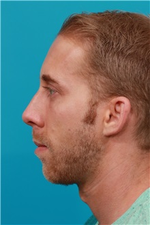 Chin Augmentation Before Photo by Michael Bogdan, MD, MBA, FACS; Grapevine, TX - Case 31852