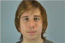 Chin Augmentation After Photo by Paul Vanek, MD, FACS; Concord, OH - Case 32717