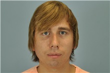 Chin Augmentation Before Photo by Paul Vanek, MD, FACS; Concord, OH - Case 32717