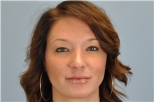 Lip Augmentation/Enhancement After Photo by Paul Vanek, MD, FACS; Concord, OH - Case 32769