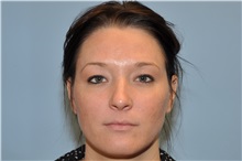 Lip Augmentation/Enhancement Before Photo by Paul Vanek, MD, FACS; Concord, OH - Case 32769